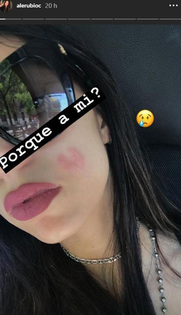 Alejandra Rubio sufre un herpes facial.