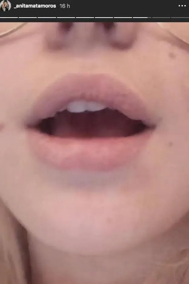 Anita Matamoros mostraba así su labio hinchado como consecuencia de una picadur de un bicho.