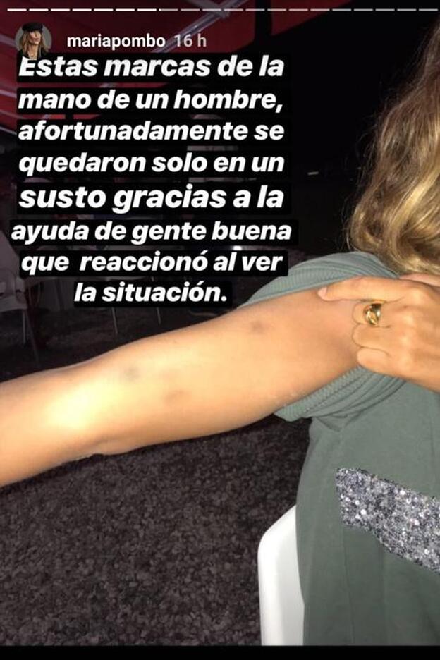 María Pombo mostró las secuelas del ataque a través de uno de sus stories de Instagram.