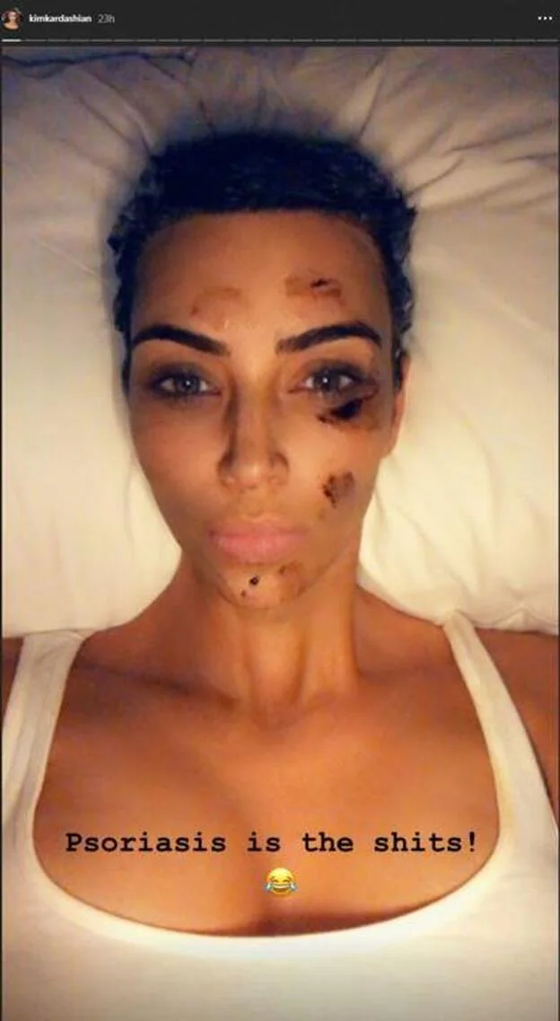 Así se le queda la cara a Kim Kardashian con la psoriasis.