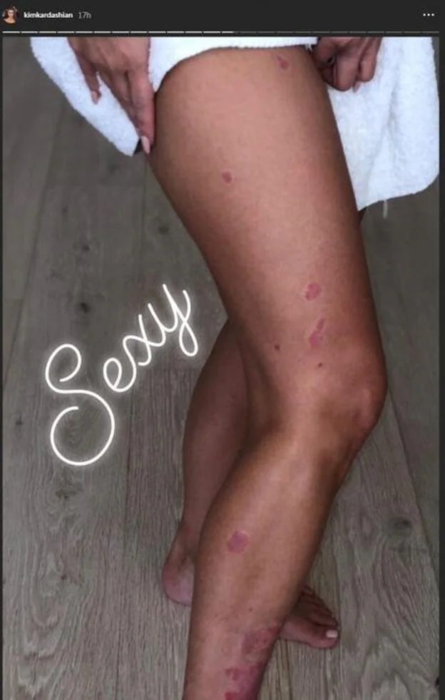 Kim Kardashian muestra las efectos de la psoriasis en sus piernas.