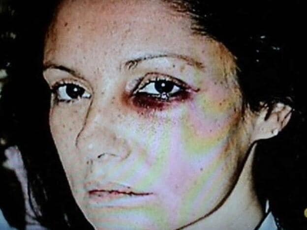 La terrible fotografía que demostró el maltrato físico que sufrió Carmina Ordóñez.