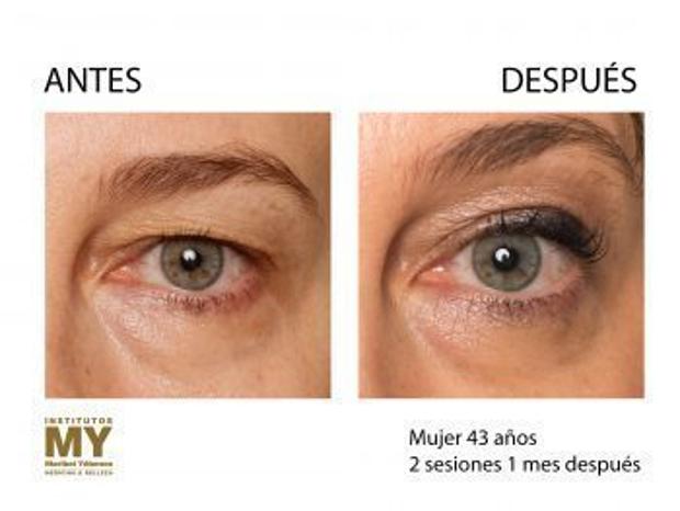 El antes y el después del Eyelid Removal de Maribel Yébenes.